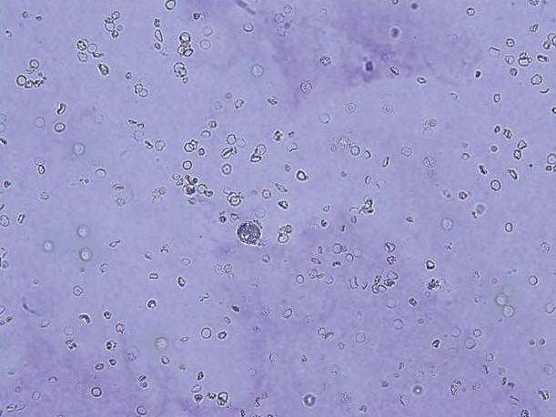 一、急性腎盂腎炎尿沉渣像